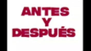 Eliminación de arrugas - Grupo Médico Clínicas Massana