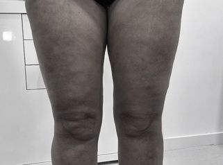 Lipedema