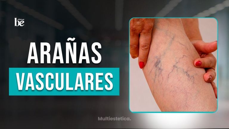 Elimina Varices y Arañas Vasculares Eficazmente