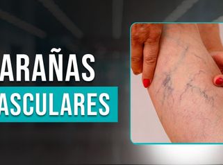 Elimina Varices y Arañas Vasculares Eficazmente