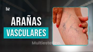 Elimina Varices y Arañas Vasculares Eficazmente