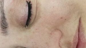 cómo se realiza la micropigmentación cómo se realiza la micropigmentación