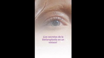 Blefaroplastia - Dra. Luz María Vásquez González