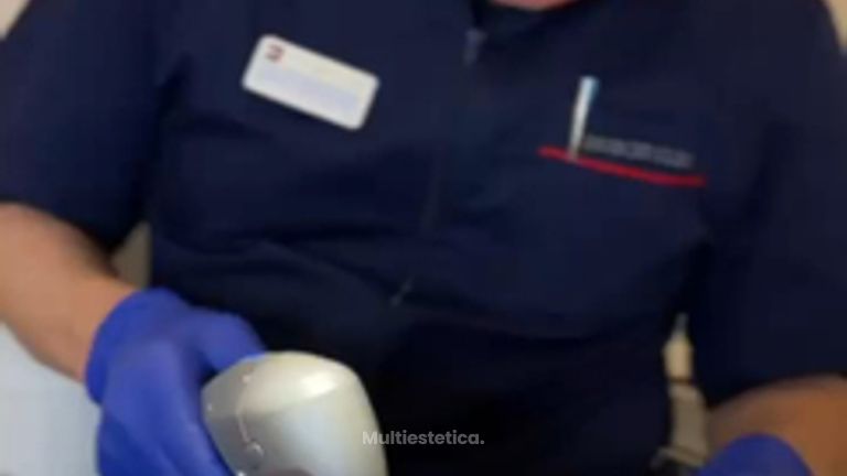 Adiós a las arrugas del labio superior con HIFU.