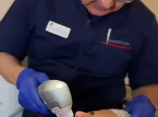 Adiós a las arrugas del labio superior con HIFU.