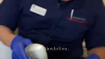 Adiós a las arrugas del labio superior con HIFU.
