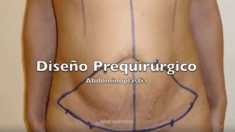 Abdominoplastia