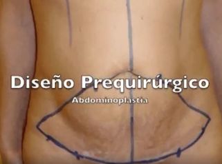 Abdominoplastia