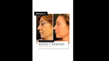 Lifting Cervicofacial - Dorsia Clinicas De Estética