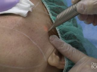 Rejuvenecimiento facial con láser