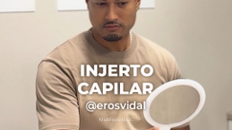 Microinjerto Capilar - Clínica Opción Médica