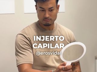 Microinjerto Capilar - Clínica Opción Médica