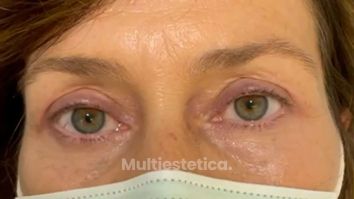 Blefaroplastia - Clínica Espías-Alonso