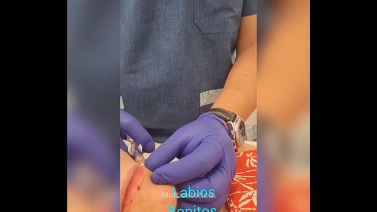 Aumento de labios - Clínica Fama
