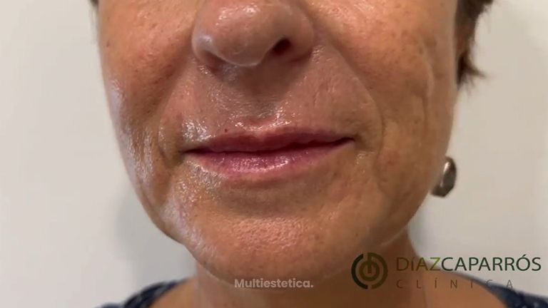 Aumento labios - Clínica Díaz Caparrós