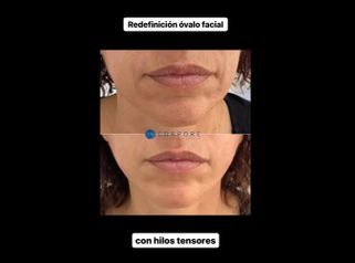Rellenos faciales - Dr. Juan Enrique Pérez Enríquez