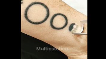 Eliminación tatuajes - Cenydiet