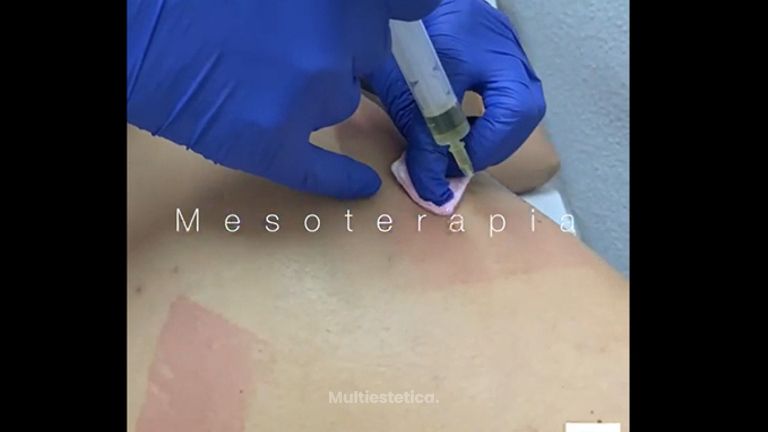 Mesoterapia - Clínica De Medicina Estética Córdoba