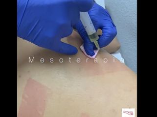 Mesoterapia - Clínica De Medicina Estética Córdoba