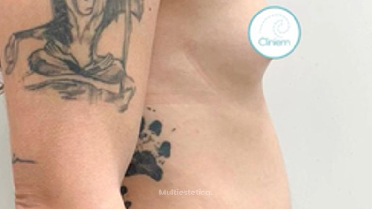 Aumento de Pecho - Cliniem
