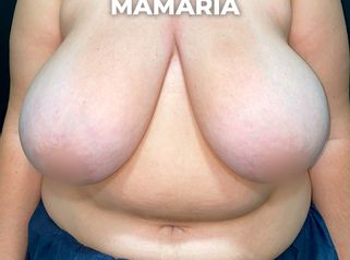 Reducción mamaria - Clínica Opción Médica