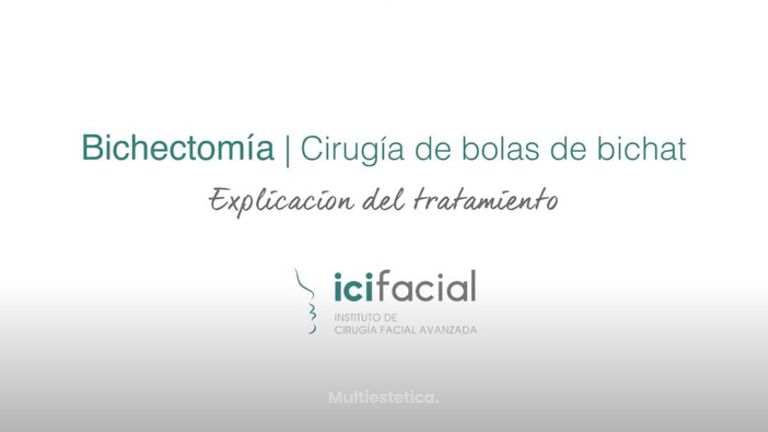 Cirugía de Bolas de Bichat o Bichectomía en Madrid por Dr Macía