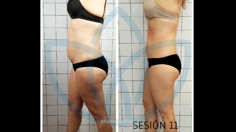 Celulitis - Clínicas Inneo