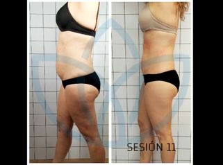Celulitis - Clínicas Inneo