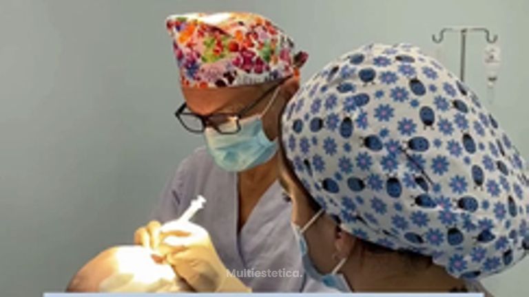 ¿Estás pensando en un Trasplante Capilar?