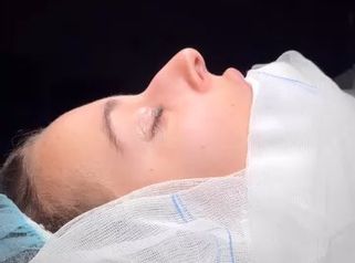 Antes y después inmediato y resultado a los 7 días