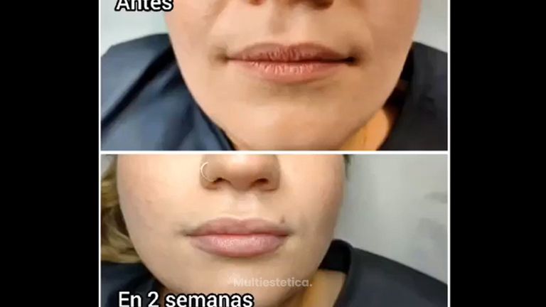 Aumento de labios - Susana & bodyStetic