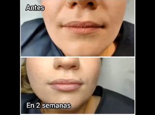 Aumento de labios - Susana & bodyStetic