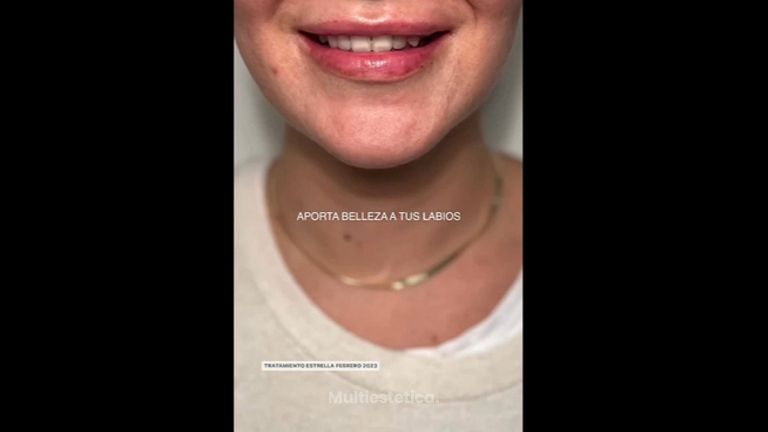 Aumento labios - Clinica Doctor Morano