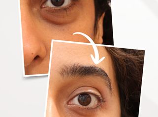 Blefaroplastia inferior transconjuntival en mujer de 35 años – Explicación del Dr. Troyano