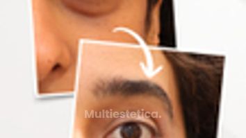 Blefaroplastia inferior transconjuntival en mujer de 35 años – Explicación del Dr. Troyano