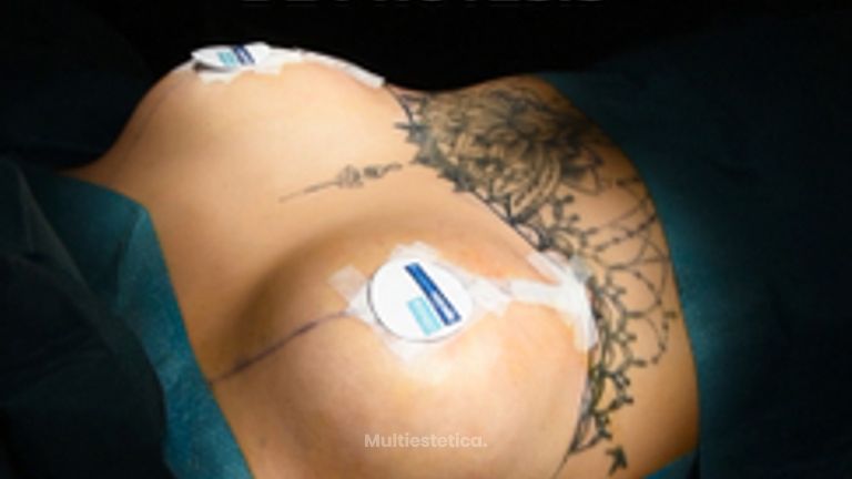 Recambio de prótesis - Clínica Opción Médica