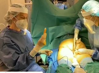 Lipofilling glúteo - Dra. Ana Martinez Padilla