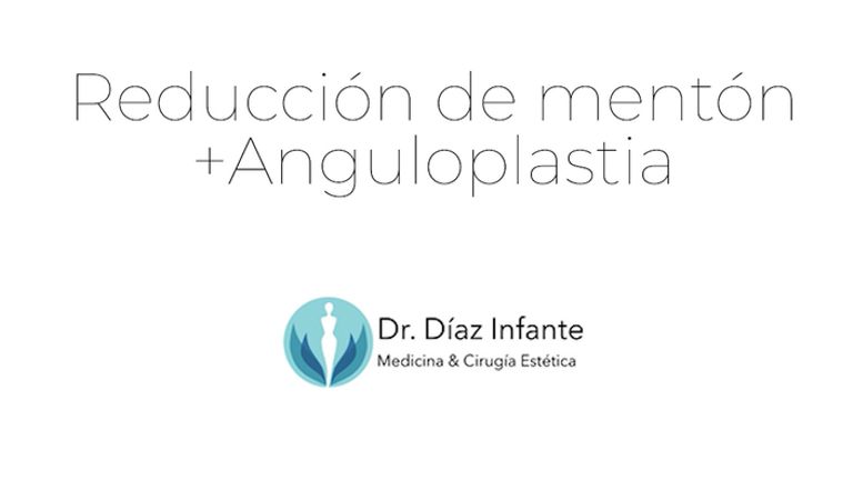 Reducción de mentón y Anguloplastia - Dr. José Luis Díaz Infante