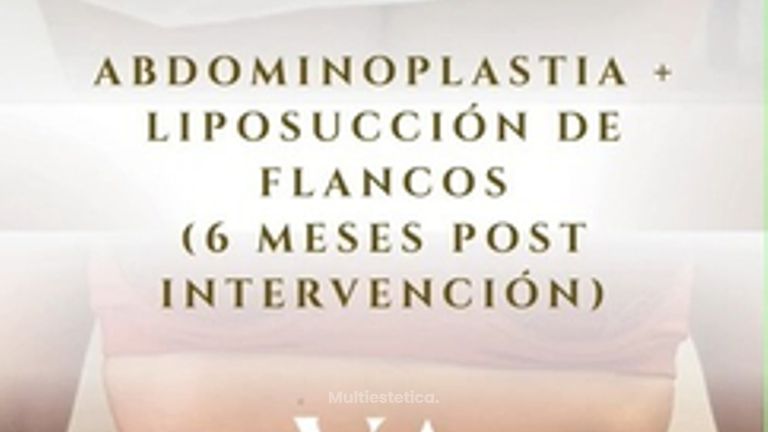 Dr. Vernetta - Abdominoplastia