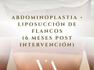 Dr. Vernetta - Abdominoplastia