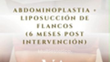 Dr. Vernetta - Abdominoplastia