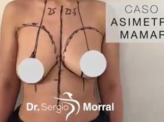 Asimetria mamaria - Dr. Sergio Morral