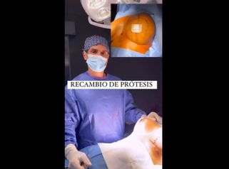Recambio de prótesis - Clínica Dr. Jiménez