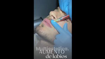 Aumento de labios - Horizon Clinics