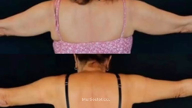 Braquioplastia. Cirugía para eliminar la grasa y flacidez de los brazos.
