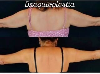 Braquioplastia. Cirugía para eliminar la grasa y flacidez de los brazos.