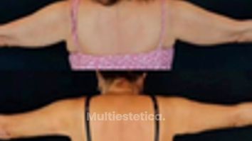 Braquioplastia. Cirugía para eliminar la grasa y flacidez de los brazos.