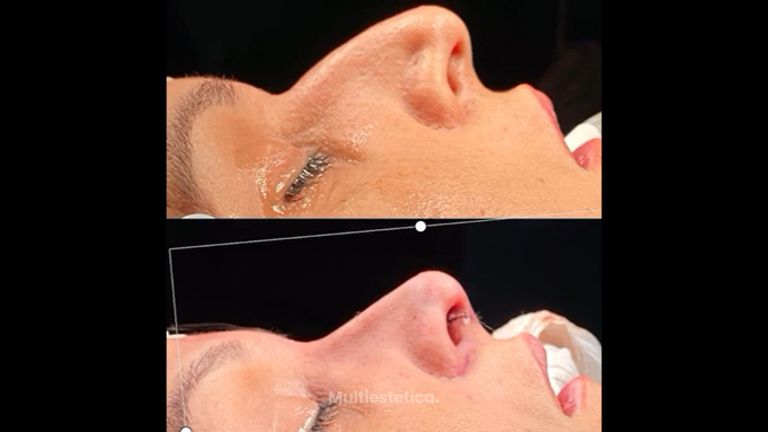 Rinoplastia (simulación y resultado real superpuestos)