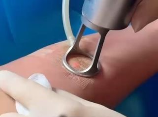WhatsApp Video LASER CO2