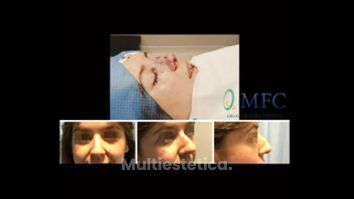 Rinoplastia